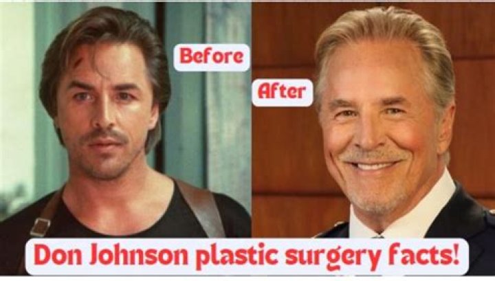 Exploring the Transformation: Don Johnson Plastic Surgery