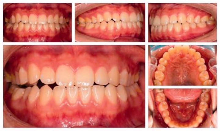 Unraveling Orthodontia Coverage: A Comprehensive Guide to Its Meaning